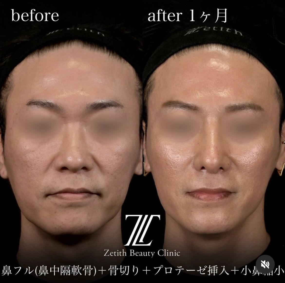 守屋医師による鼻整形の施術前／施術後1ヶ月