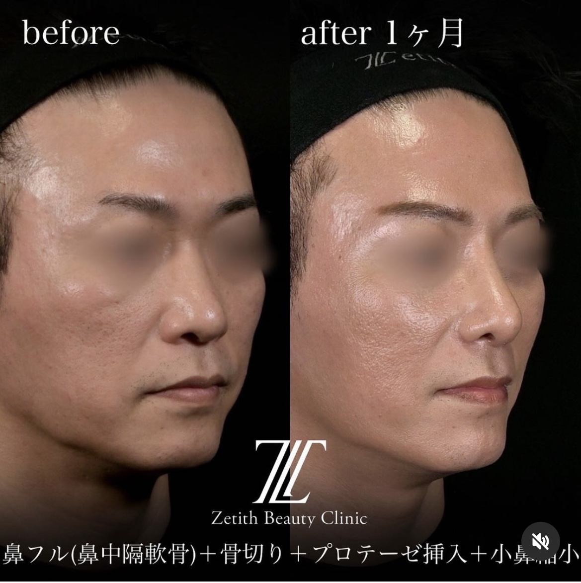 守屋医師による鼻整形の施術前／施術後1ヶ月 施術後 