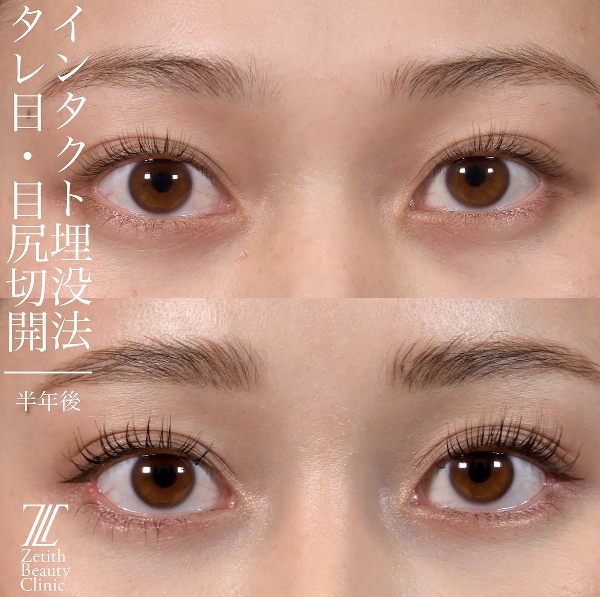 上木原医師による目元整形の施術前／施術後6ヶ月