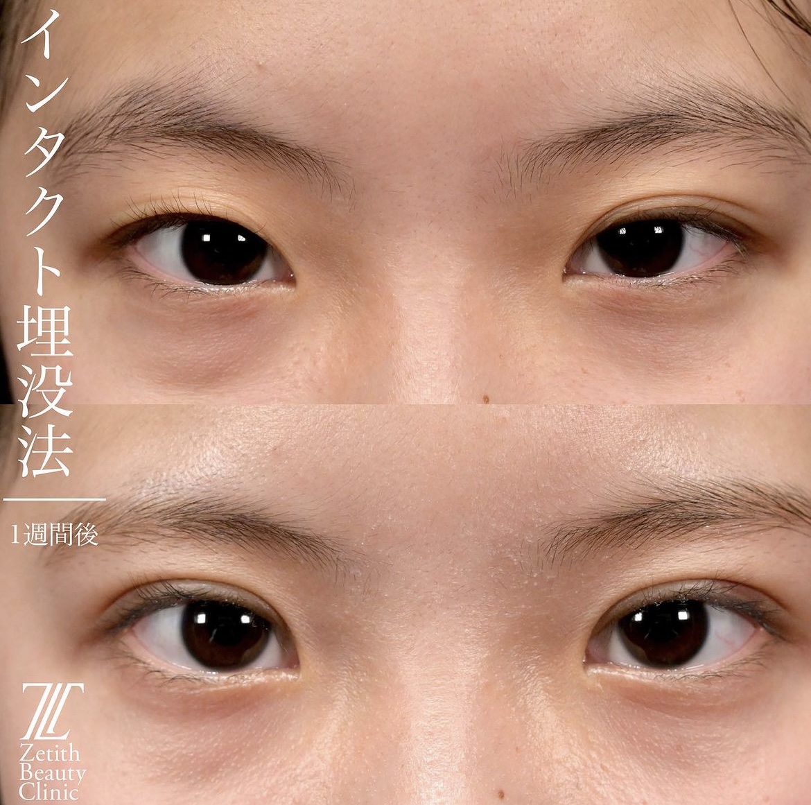 上木原医師による目元整形の施術前／施術後1週間
