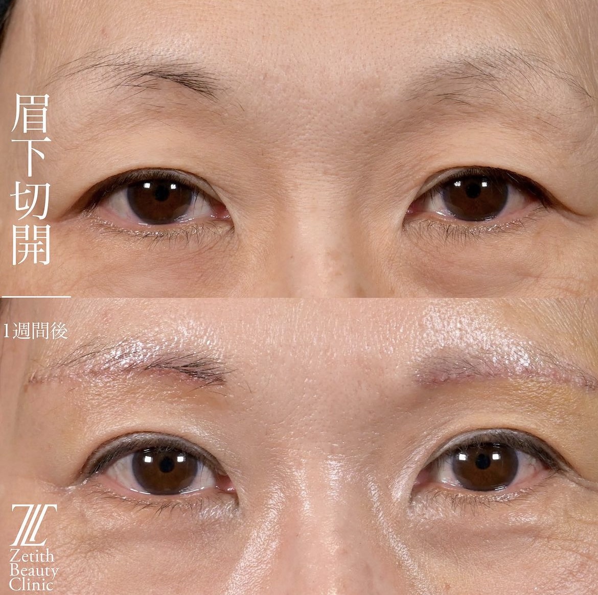 上木原医師による眉下切開の施術前／施術後1週間