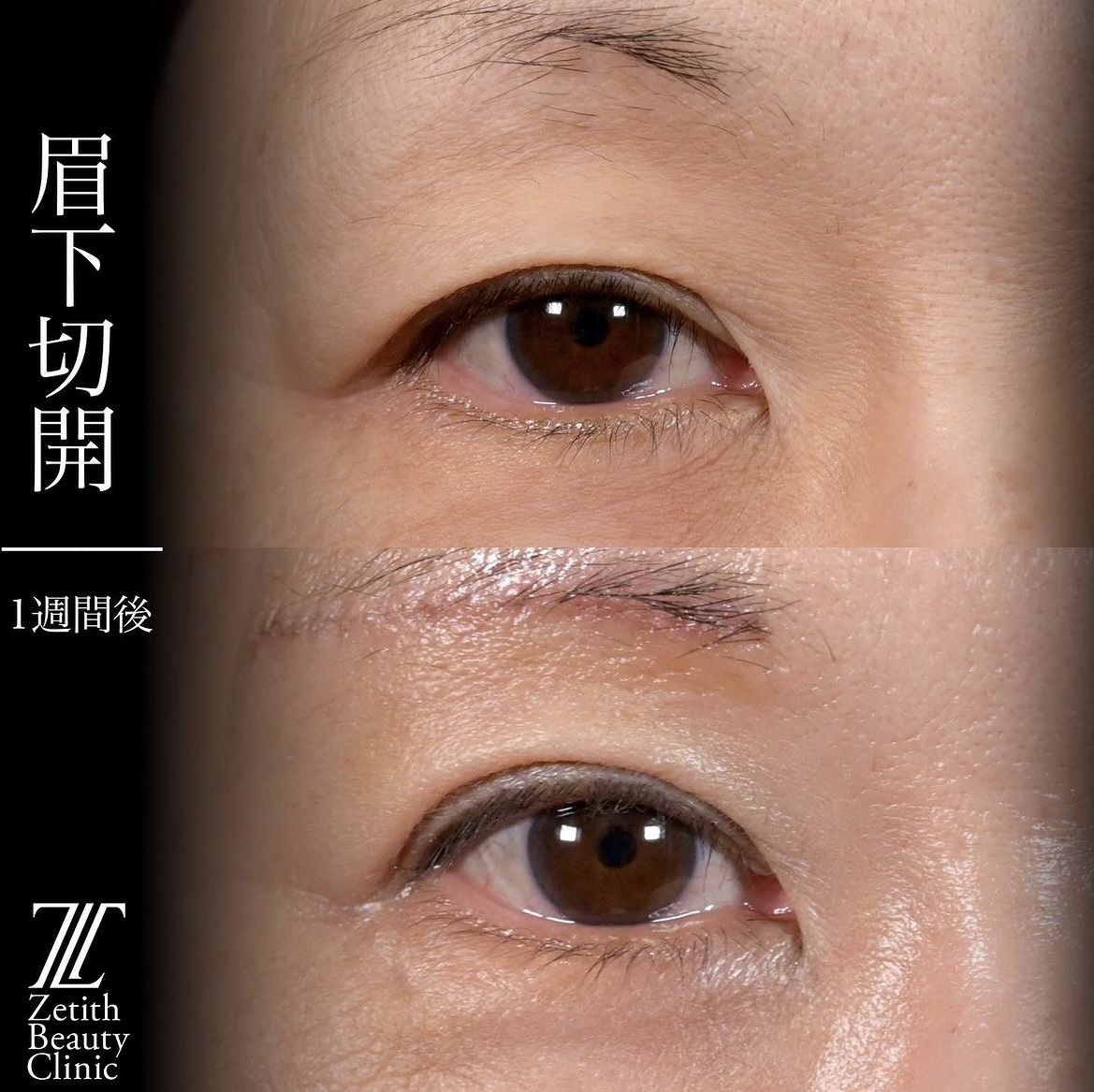 上木原医師による眉下切開の施術前／施術後1週間 Дараа 