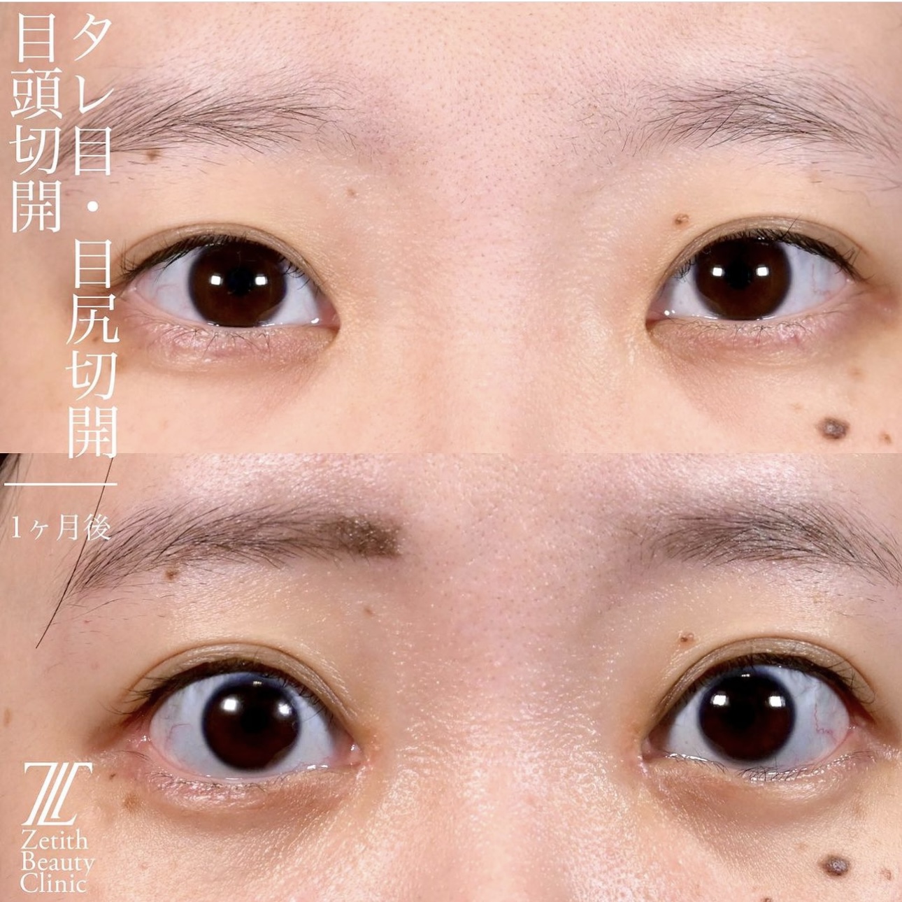 上木原医師による目元整形の施術前／施術後1ヶ月
