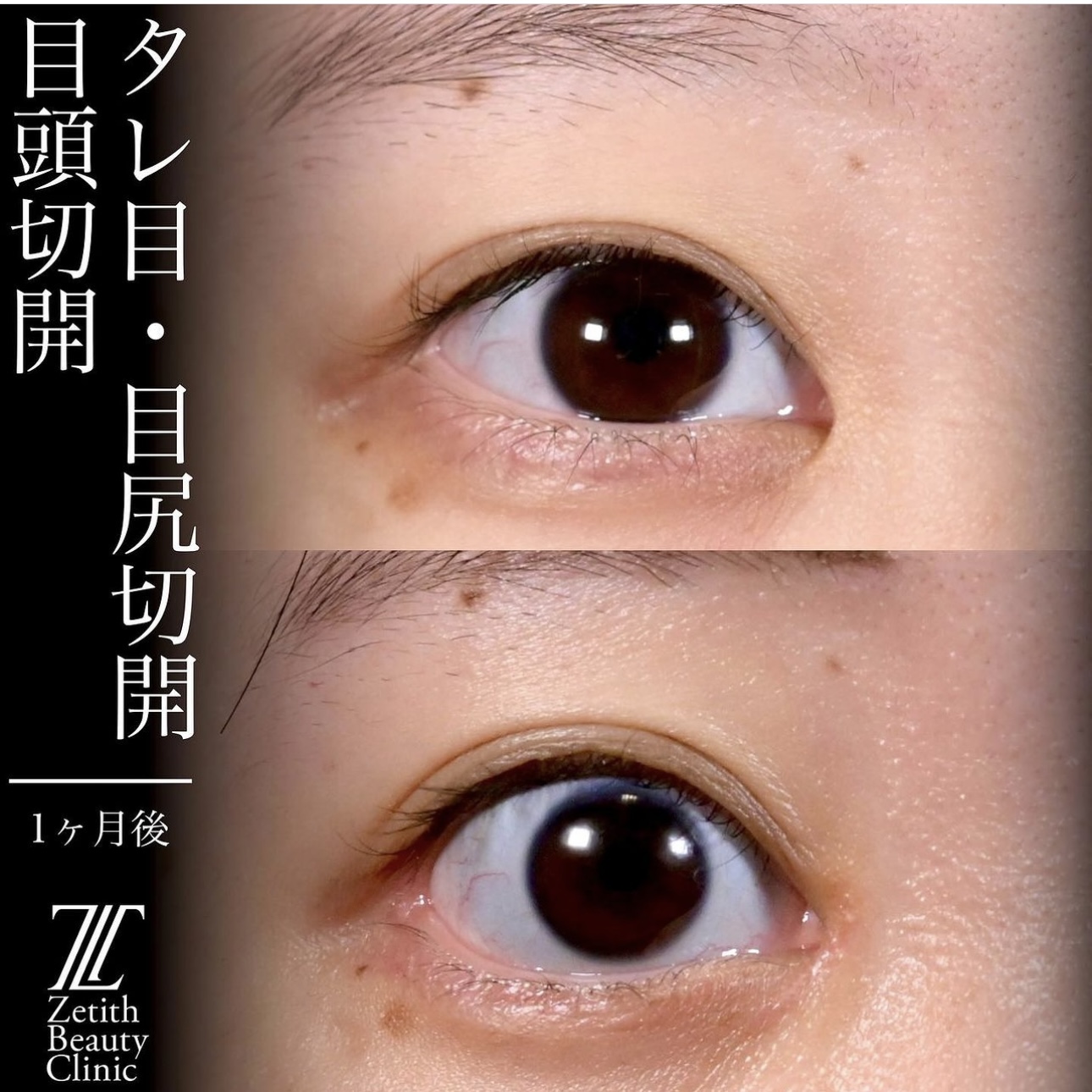 上木原医師による目元整形の施術前／施術後1ヶ月 Sonra 