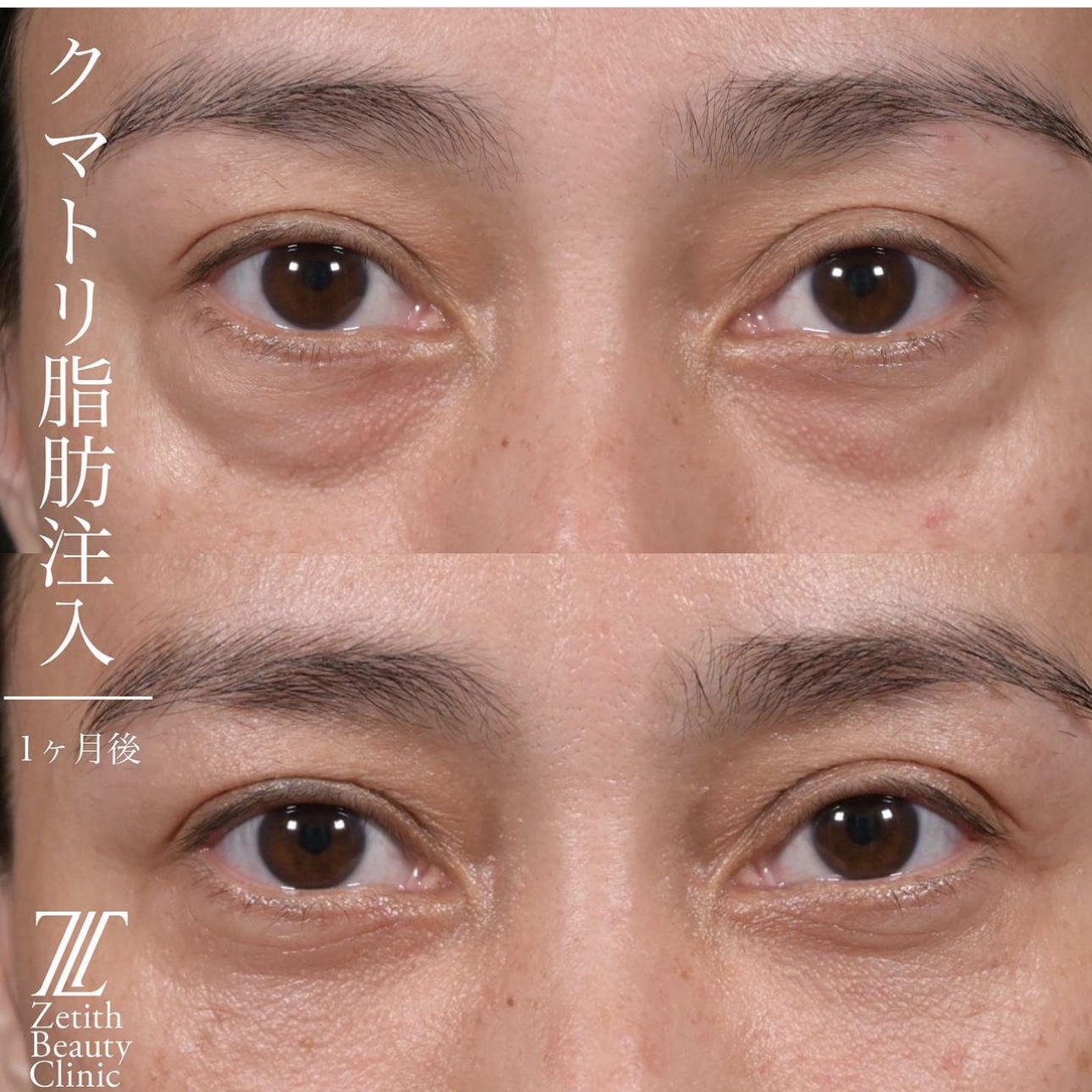上木原医師によるクマ治療の施術前／施術後1ヶ月