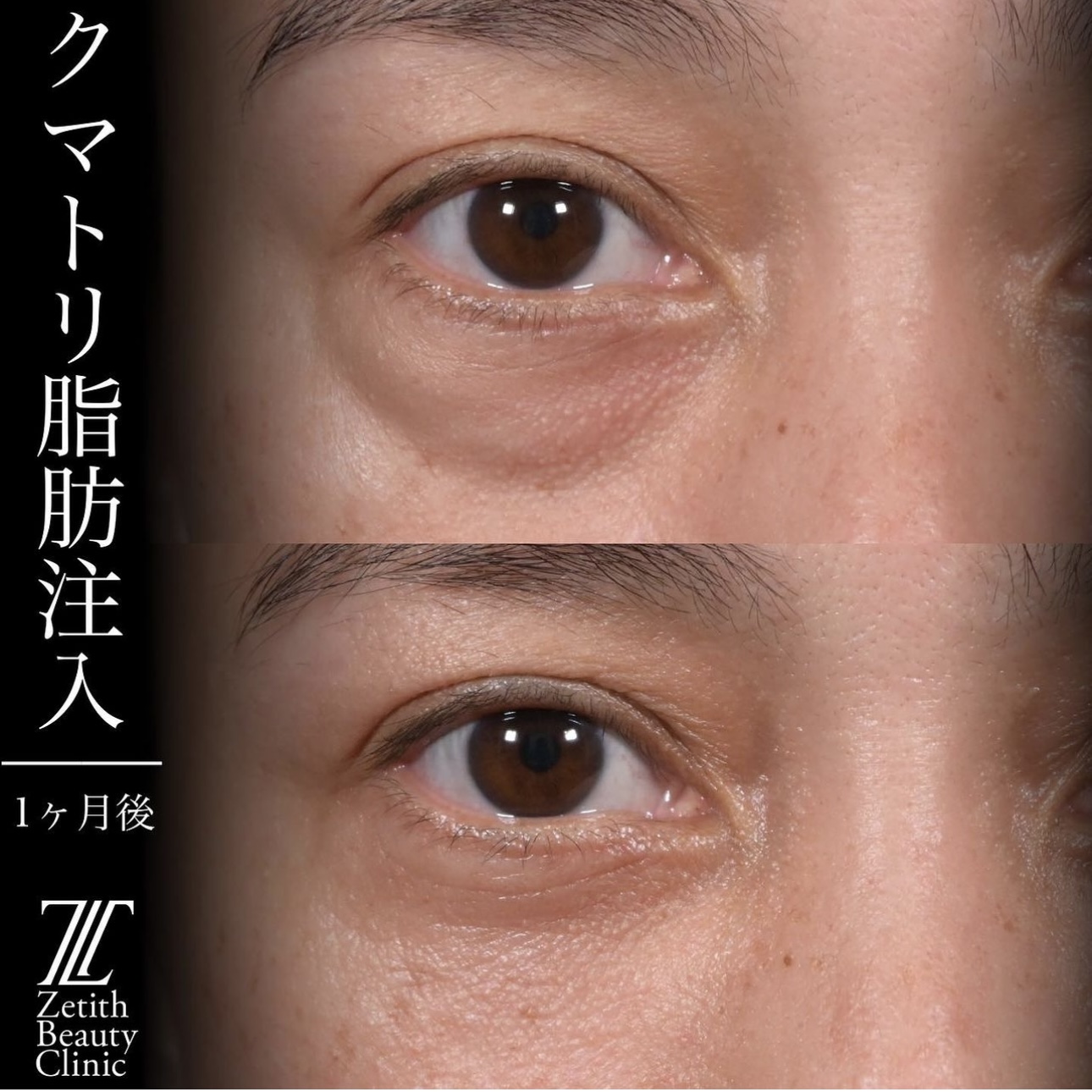 上木原医師によるクマ治療の施術前／施術後1ヶ月 Дараа 