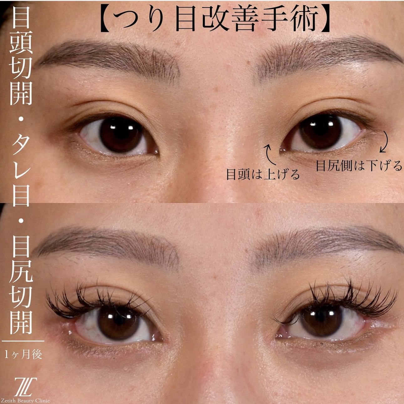 上木原医師による目元整形の施術前／施術後1ヶ月