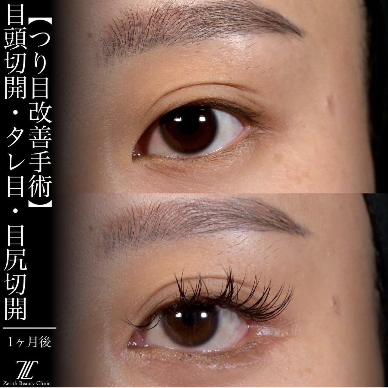 上木原医師による目元整形の施術前／施術後1ヶ月 Sau 