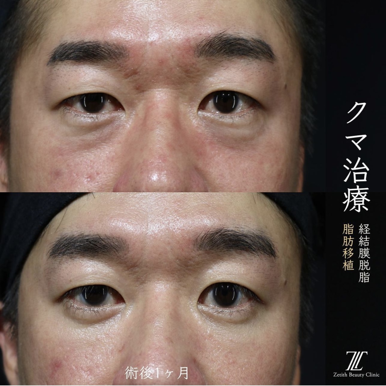 王医師によるクマ治療の施術前／施術後1ヶ月