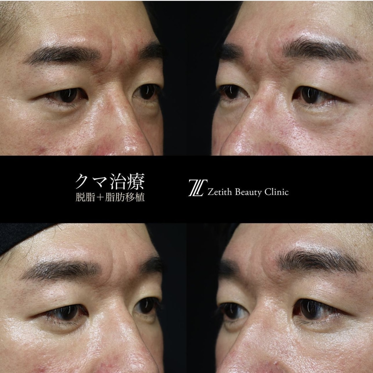 王医師によるクマ治療の施術前／施術後1ヶ月 Sau 