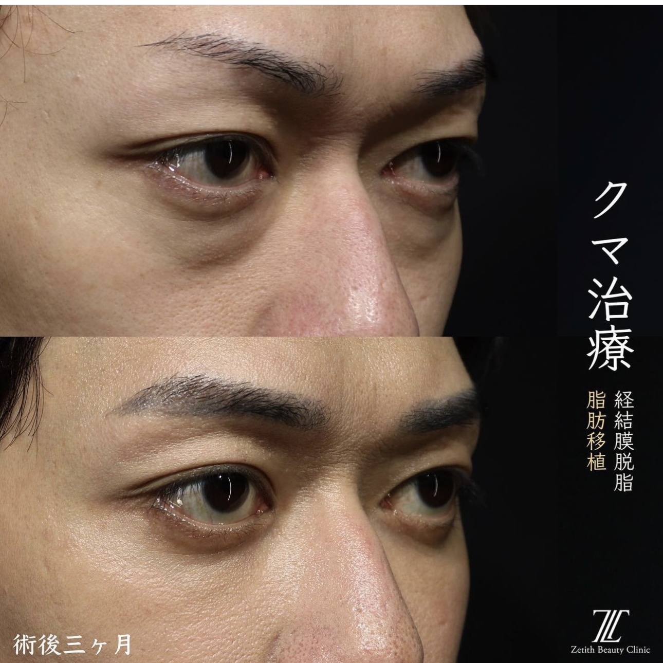 王医師によるクマ治療の施術前／施術後3ヶ หลัง 