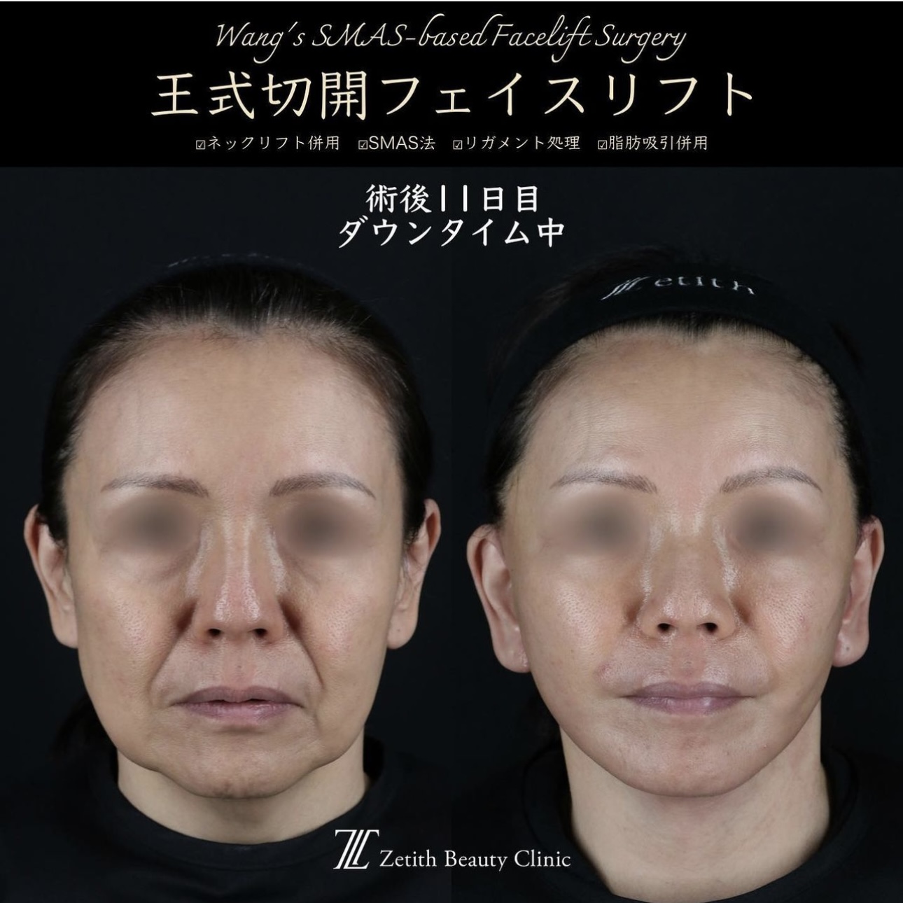 王医師による複合治療の施術前／施術後11日