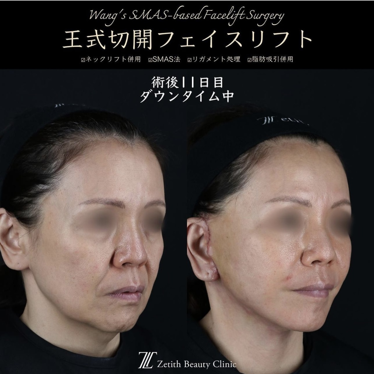 王医師による複合治療の施術前／施術後11日 施術後 