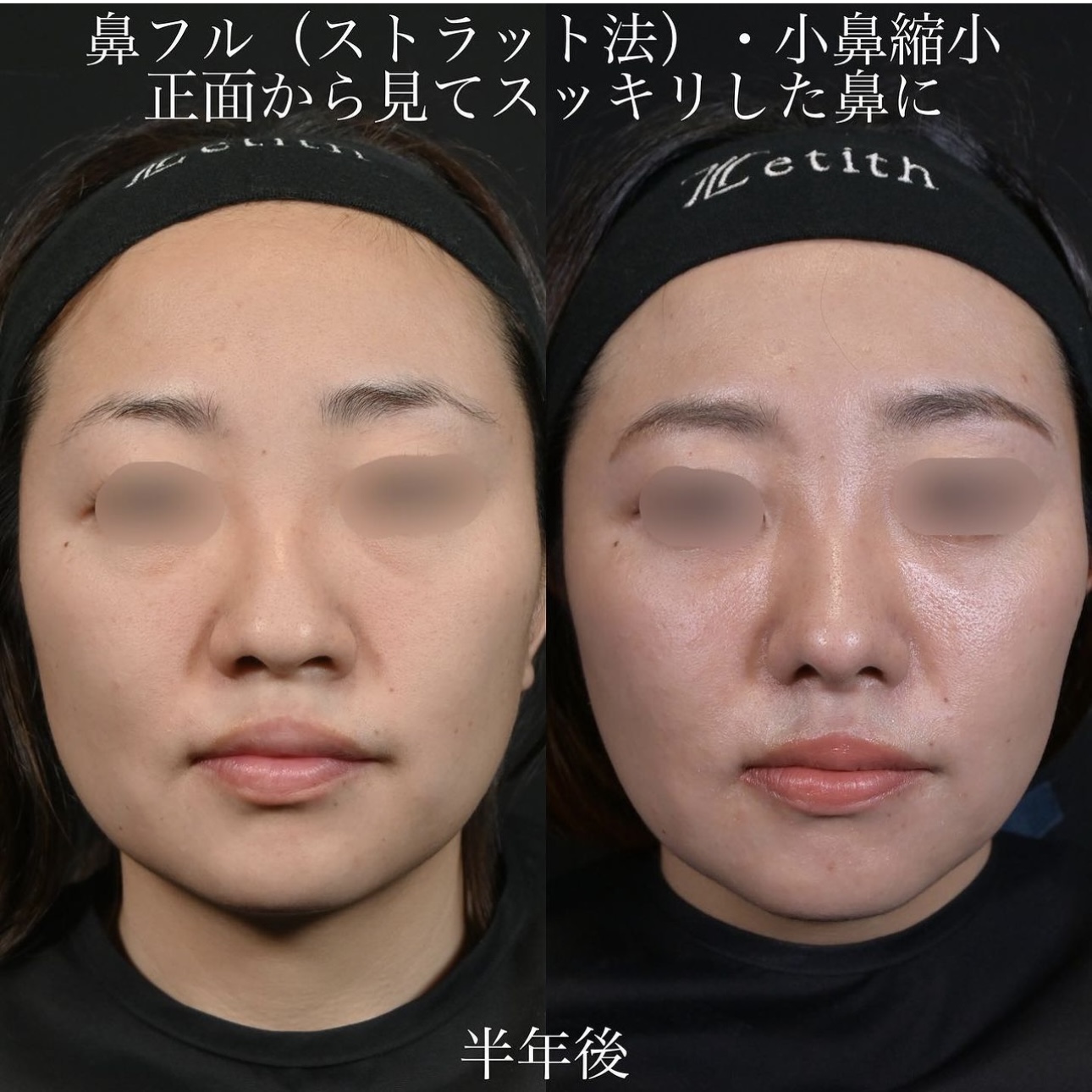 上木原医師による鼻整形の施術前／施術後6ヶ月
