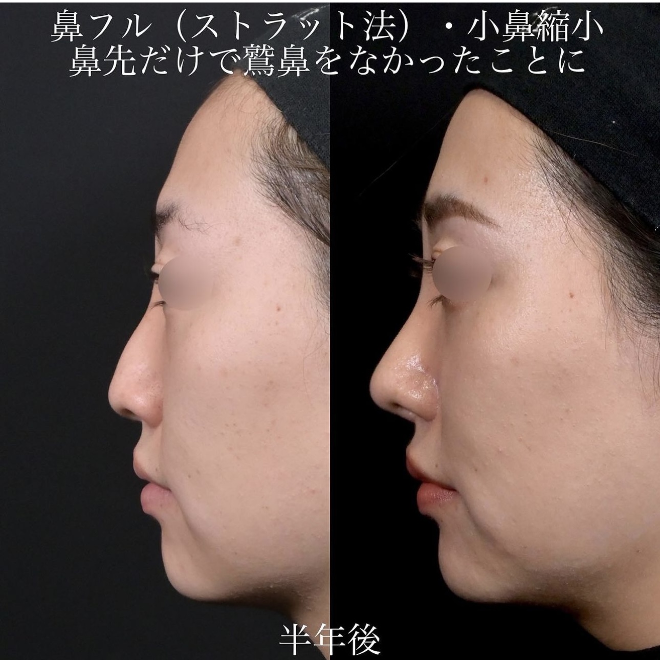 上木原医師による鼻整形の施術前／施術後6ヶ月 หลัง 