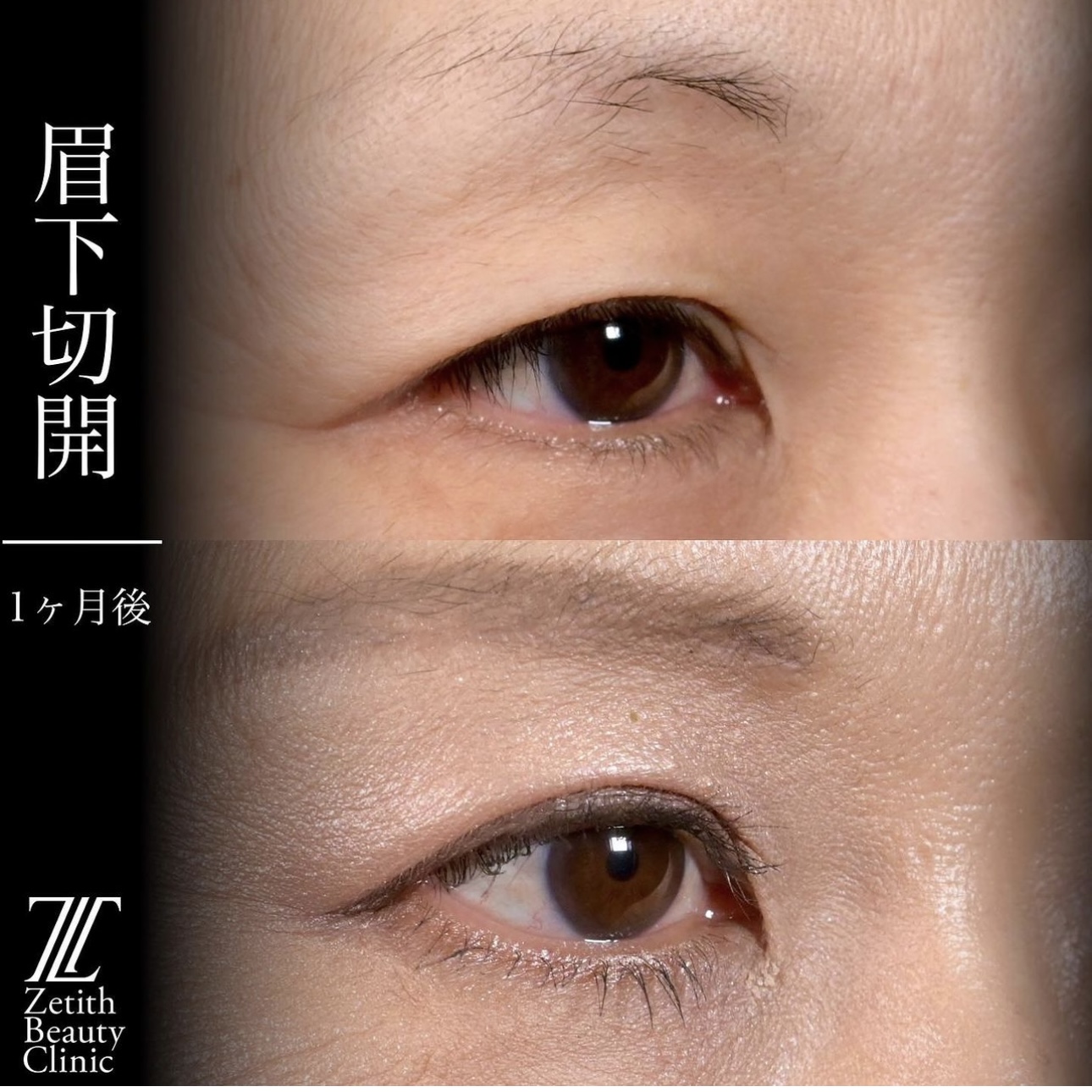 上木原医師による眉下切開の施術前／施術後1ヶ月 术后 