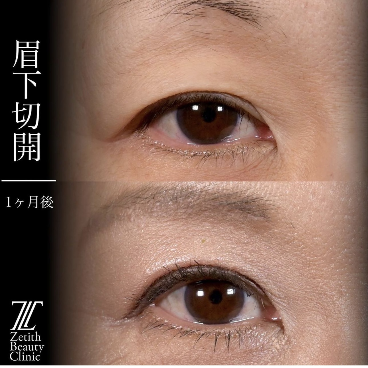上木原医師による眉下切開の施術前／施術後1ヶ月