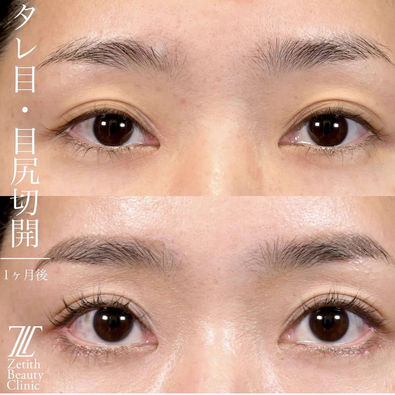 上木原医師によるタレ目形成の施術前／施術後1ヶ月