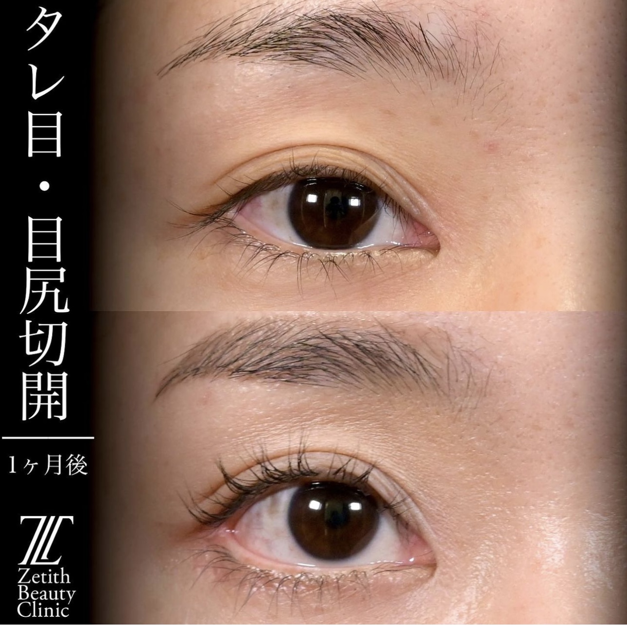 上木原医師によるタレ目形成の施術前／施術後1ヶ月 术后 