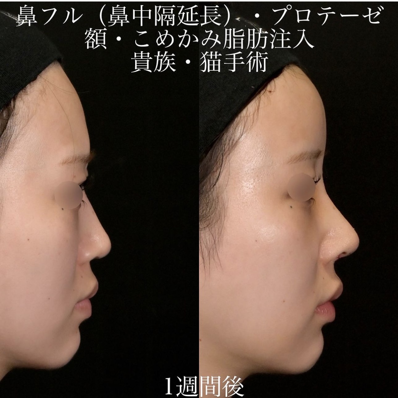 上木原医師による鼻整形の施術前／施術後1週間