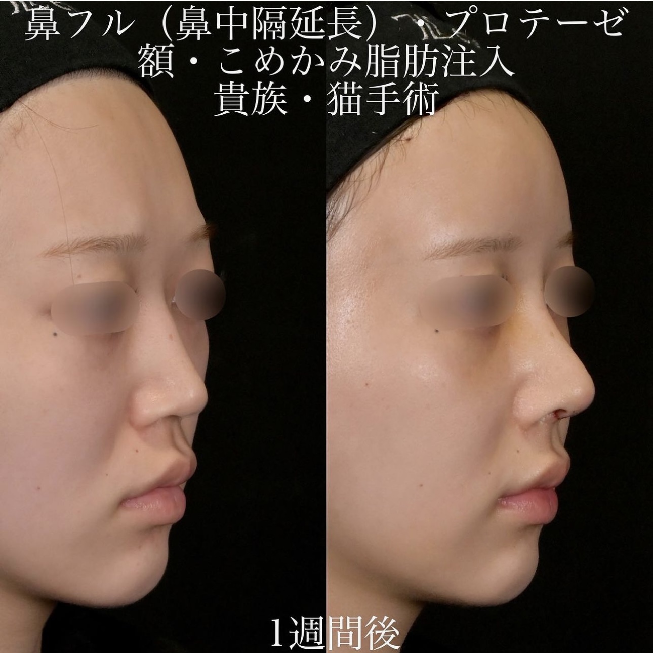 上木原医師による鼻整形の施術前／施術後1週間 Sau 