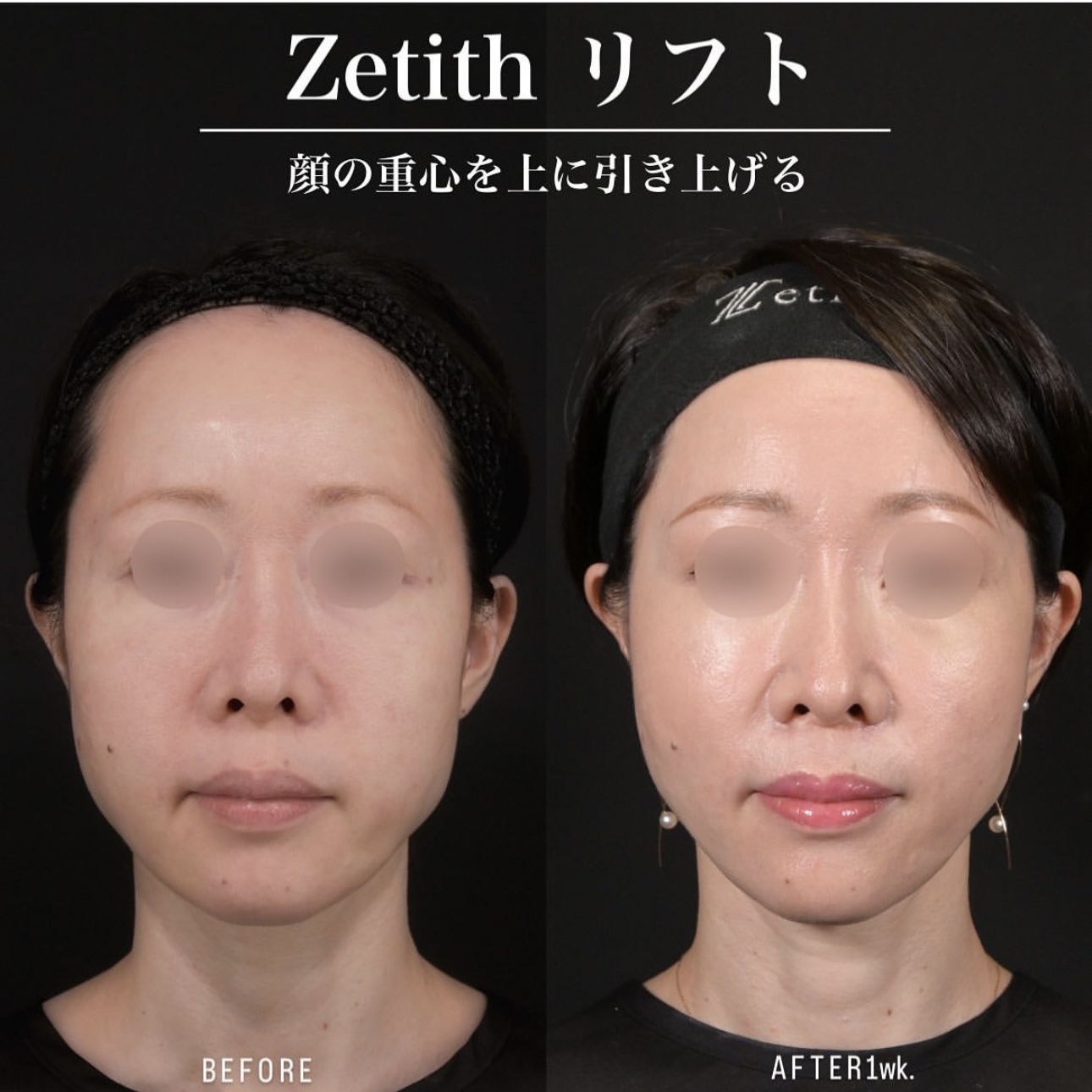 新井医師による糸リフトの施術前／施術後1週間