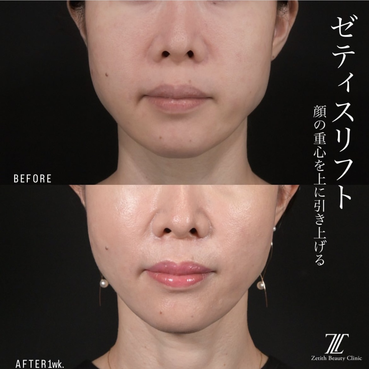 新井医師による糸リフトの施術前／施術後1週間 施術後 
