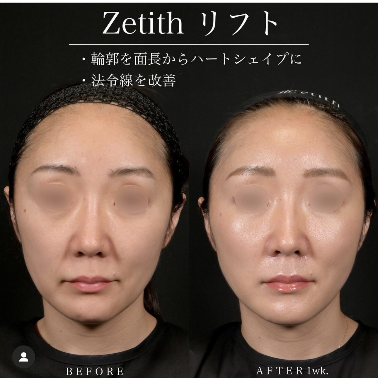 新井医師による糸リフトの施術前／施術後1週間