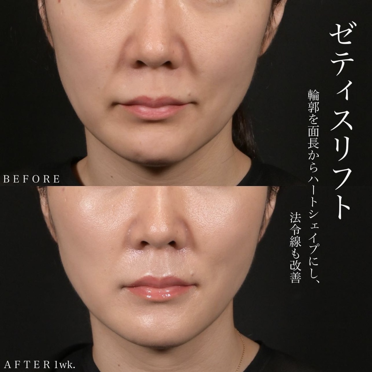 新井医師による糸リフトの施術前／施術後1週間 Sau 