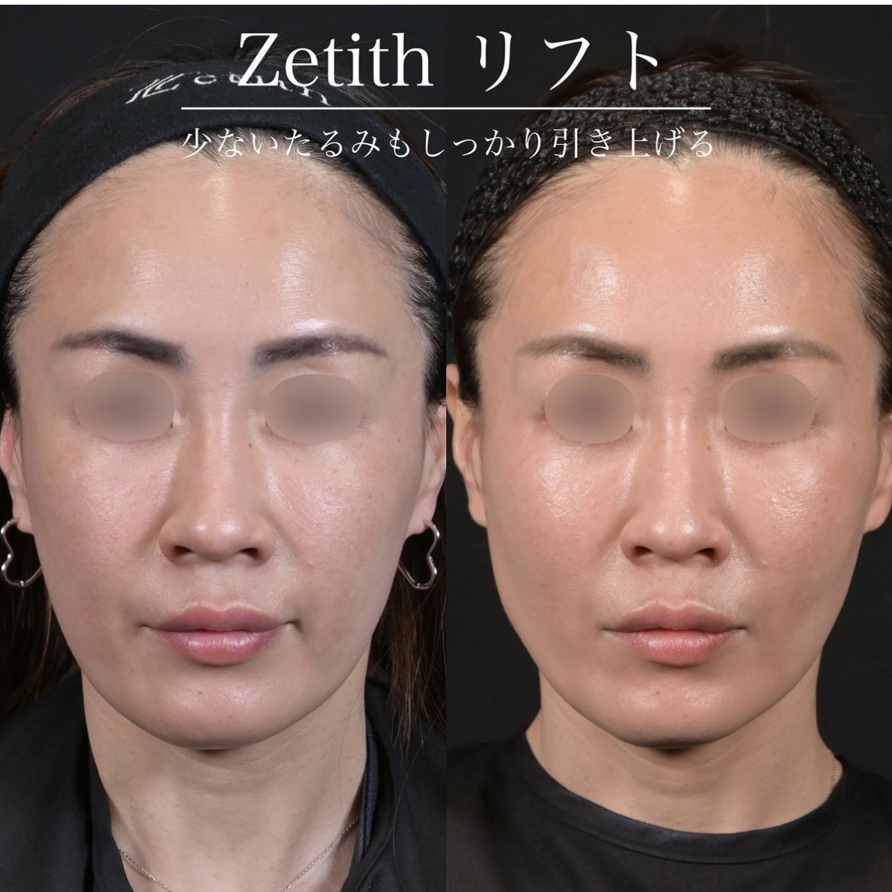 新井医師による糸リフトの施術前／施術後1ヶ月