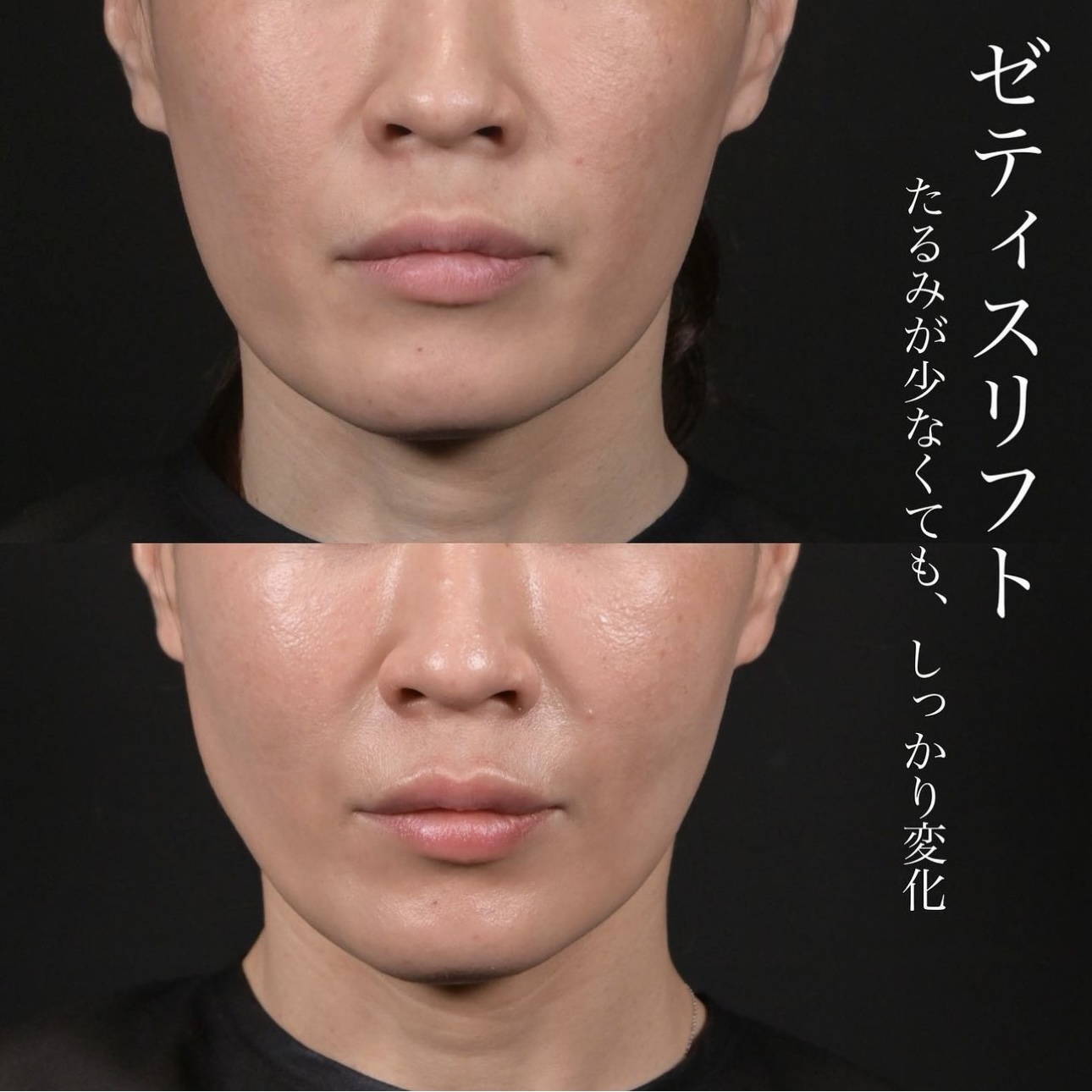 新井医師による糸リフトの施術前／施術後1ヶ月 Дараа 
