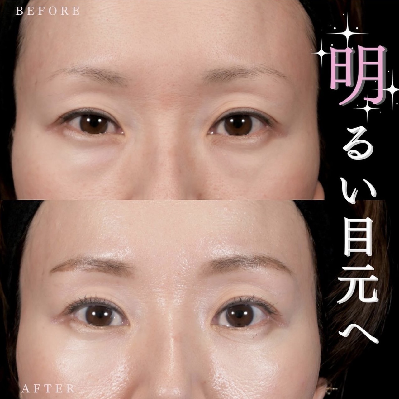 新井医師によるクマ治療の施術前／施術後ヶ月