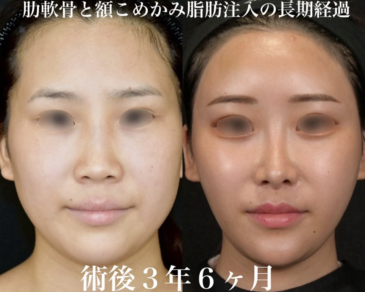 鉄医師による鼻整形の施術前／施術後3年6ヶ月