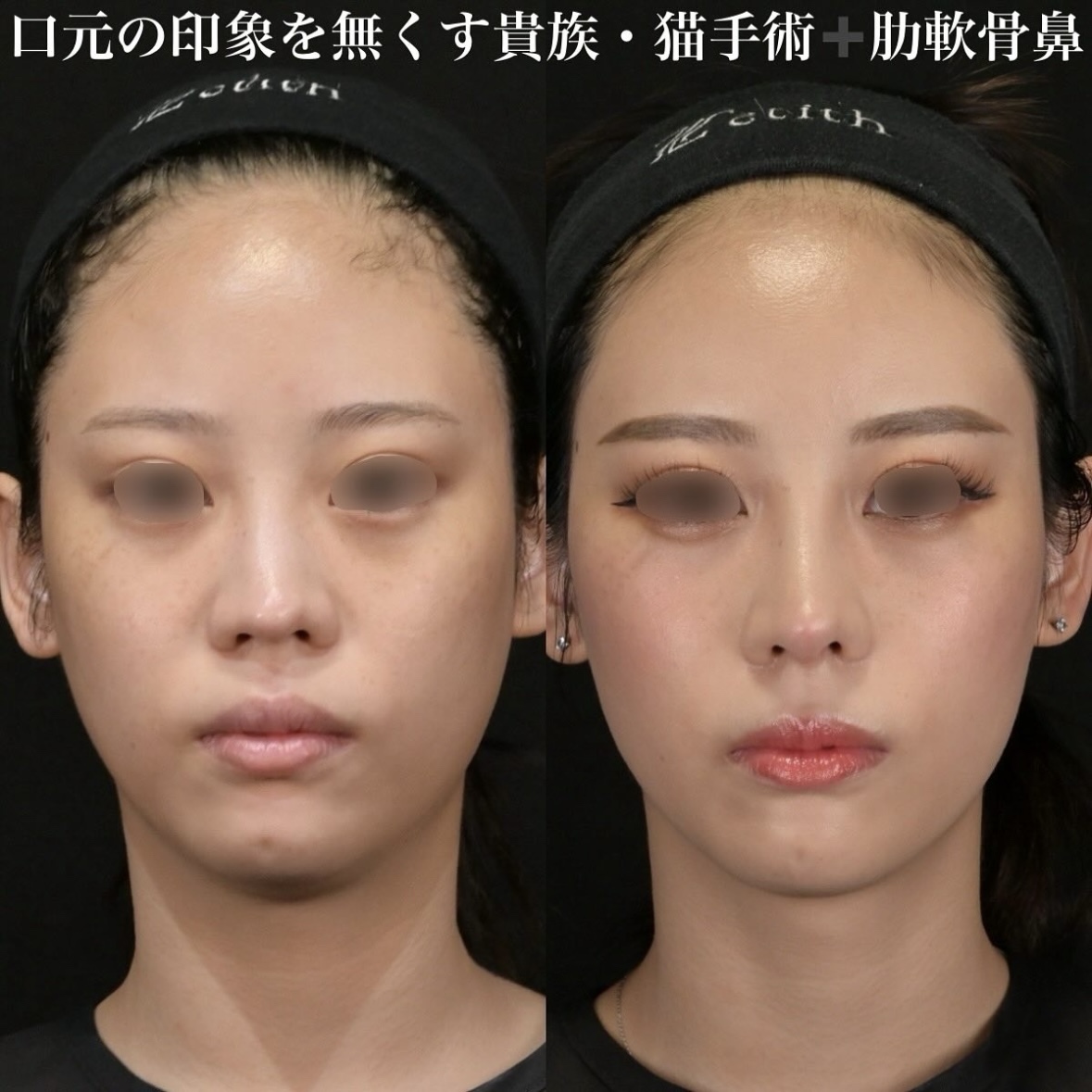 鉄医師による鼻整形の施術前／施術後1ヶ月