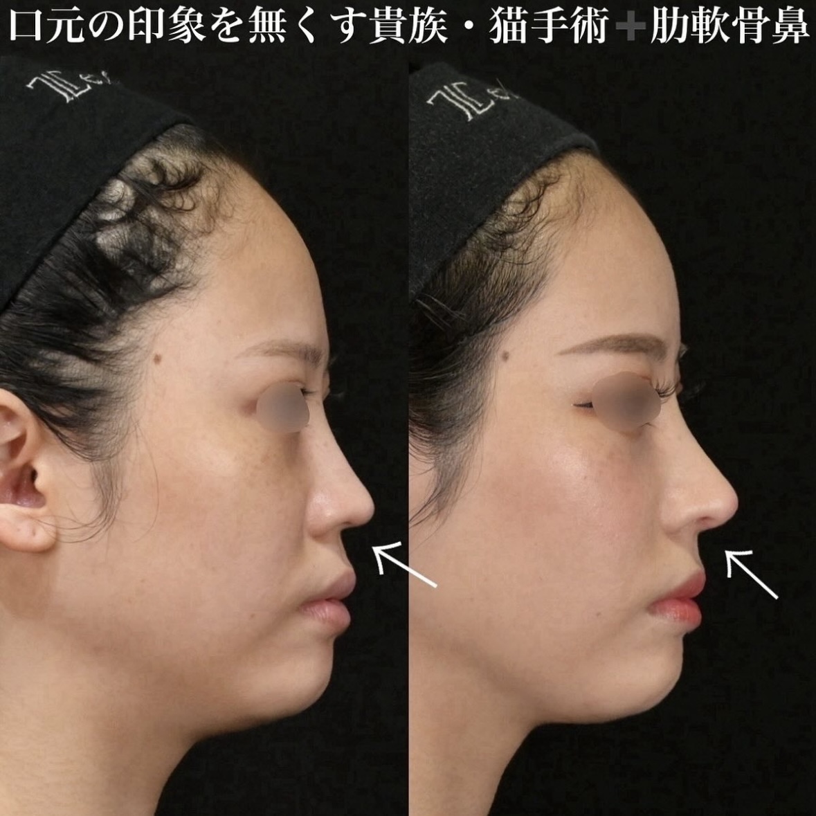 鉄医師による鼻整形の施術前／施術後1ヶ月 施術後 