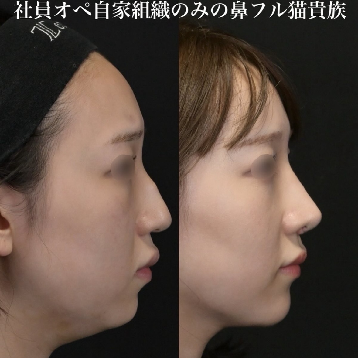 鉄医師による鼻整形の施術前／施術後1ヶ月