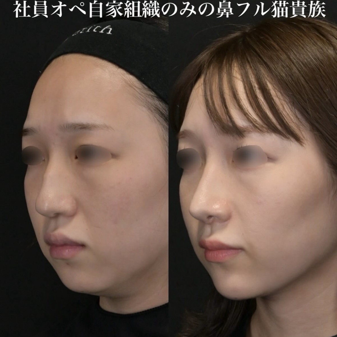 鉄医師による鼻整形の施術前／施術後1ヶ月 Дараа 