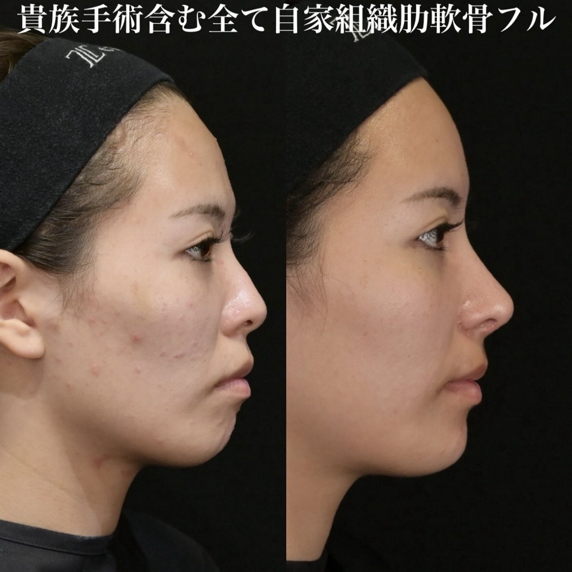 鉄医師による鼻整形の施術前／施術後1ヶ月