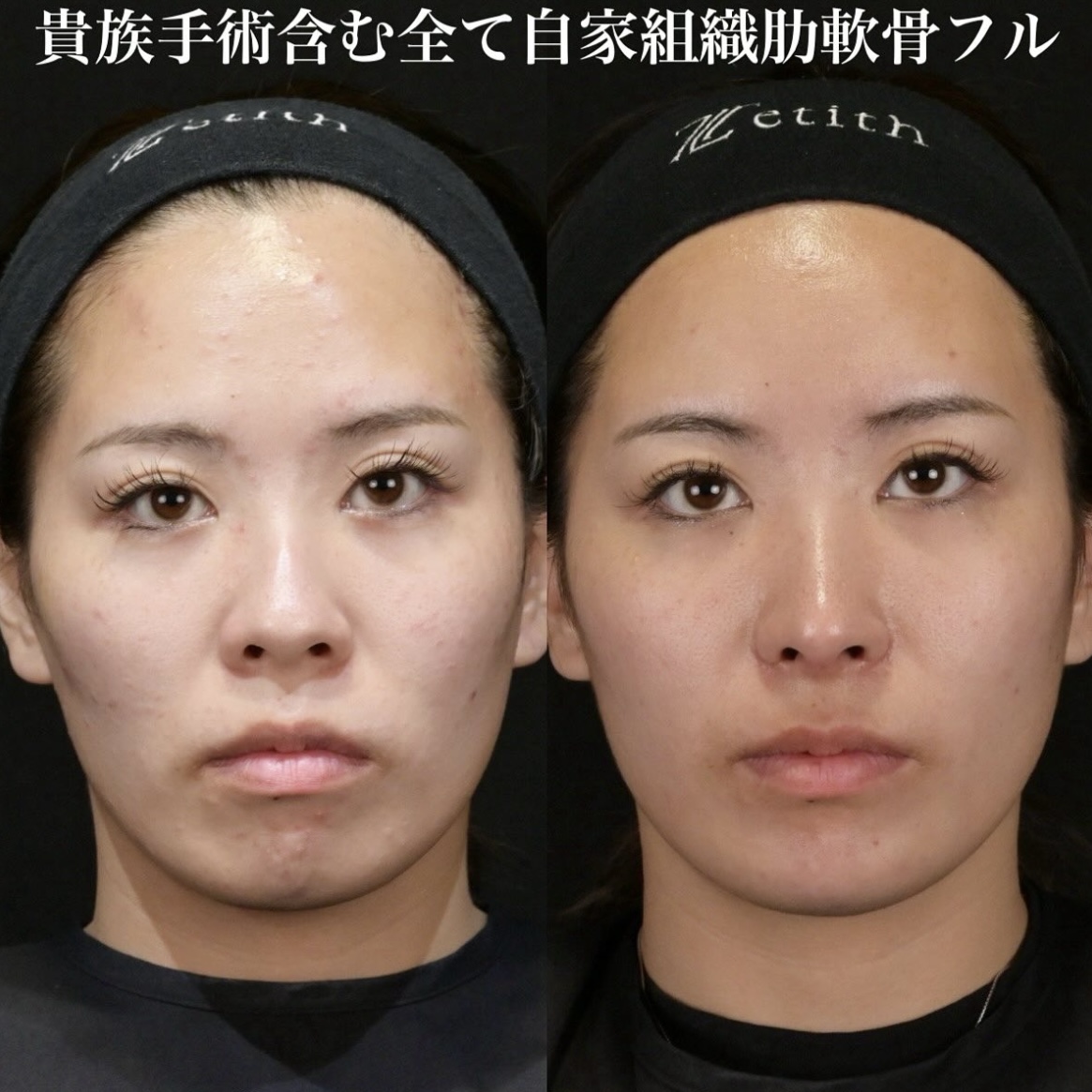 鉄医師による鼻整形の施術前／施術後1ヶ月 术后 