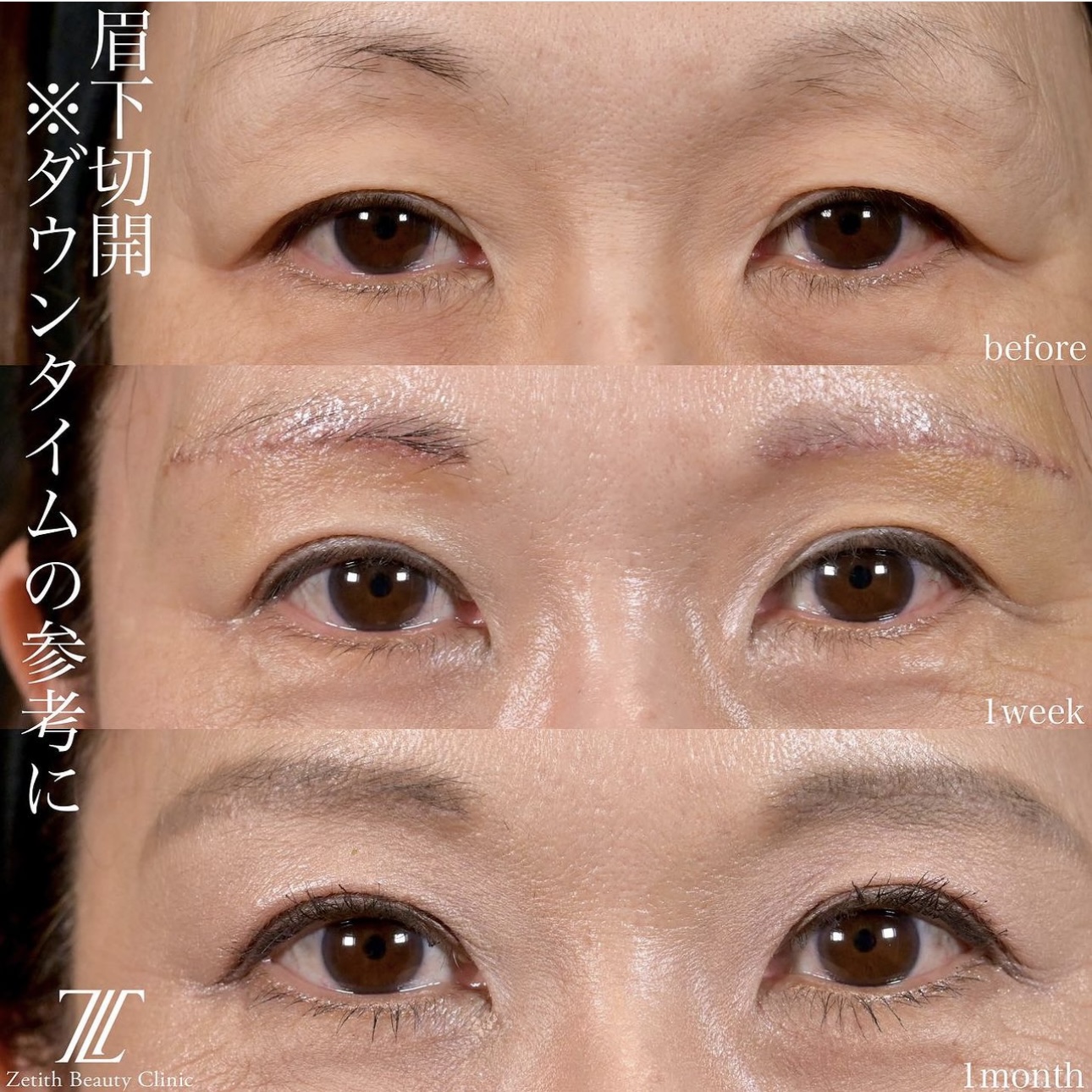 上木原医師による眉下切開の施術前／施術後1週間／1ヶ月