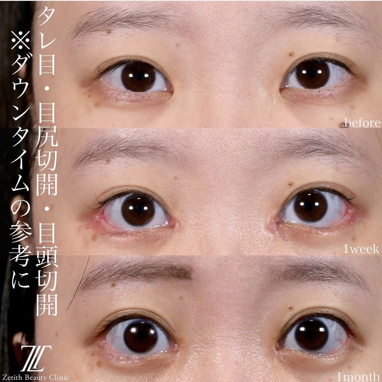 上木原医師による目元整形の施術前／施術後1週間／1ヶ月