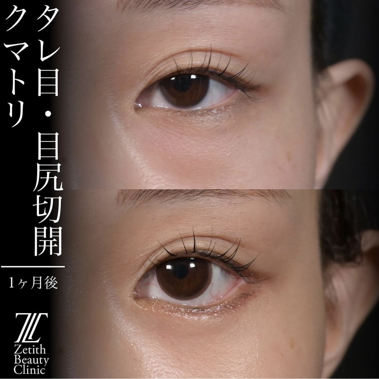 上木原医師による目元整形の施術前／施術後1ヶ月
