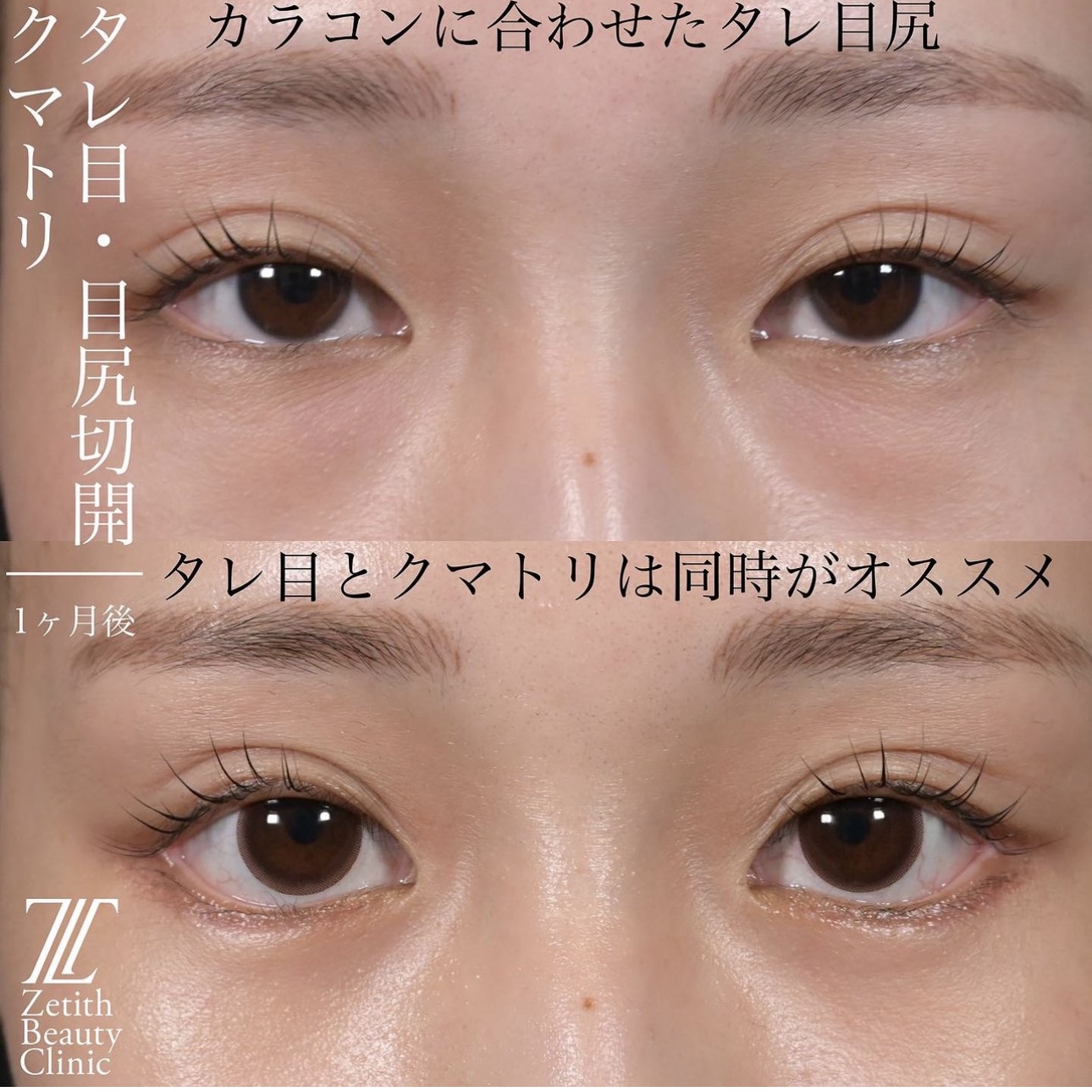 上木原医師による目元整形の施術前／施術後1ヶ月 بعد 