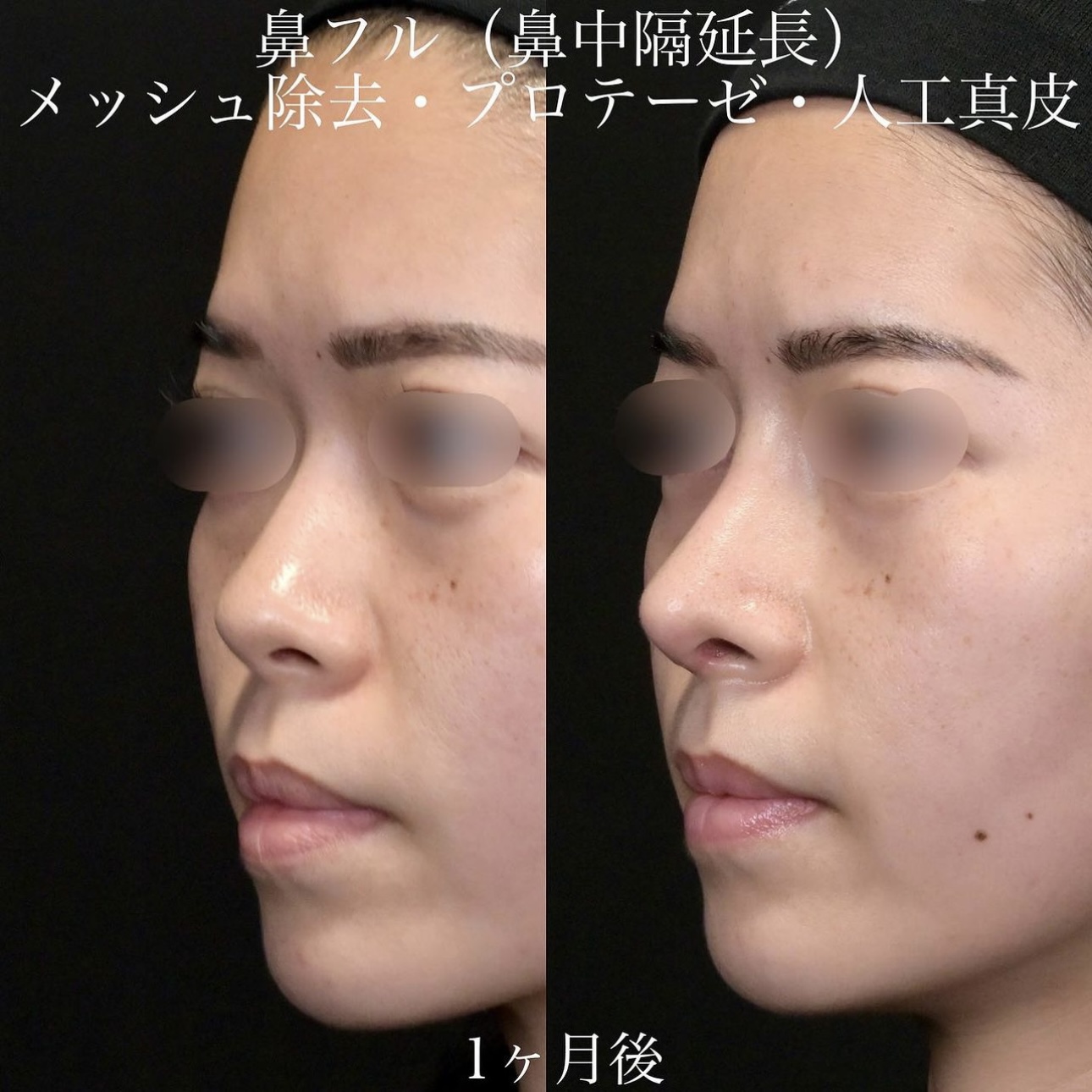 上木原医師による鼻整形の施術前／施術後1ヶ月