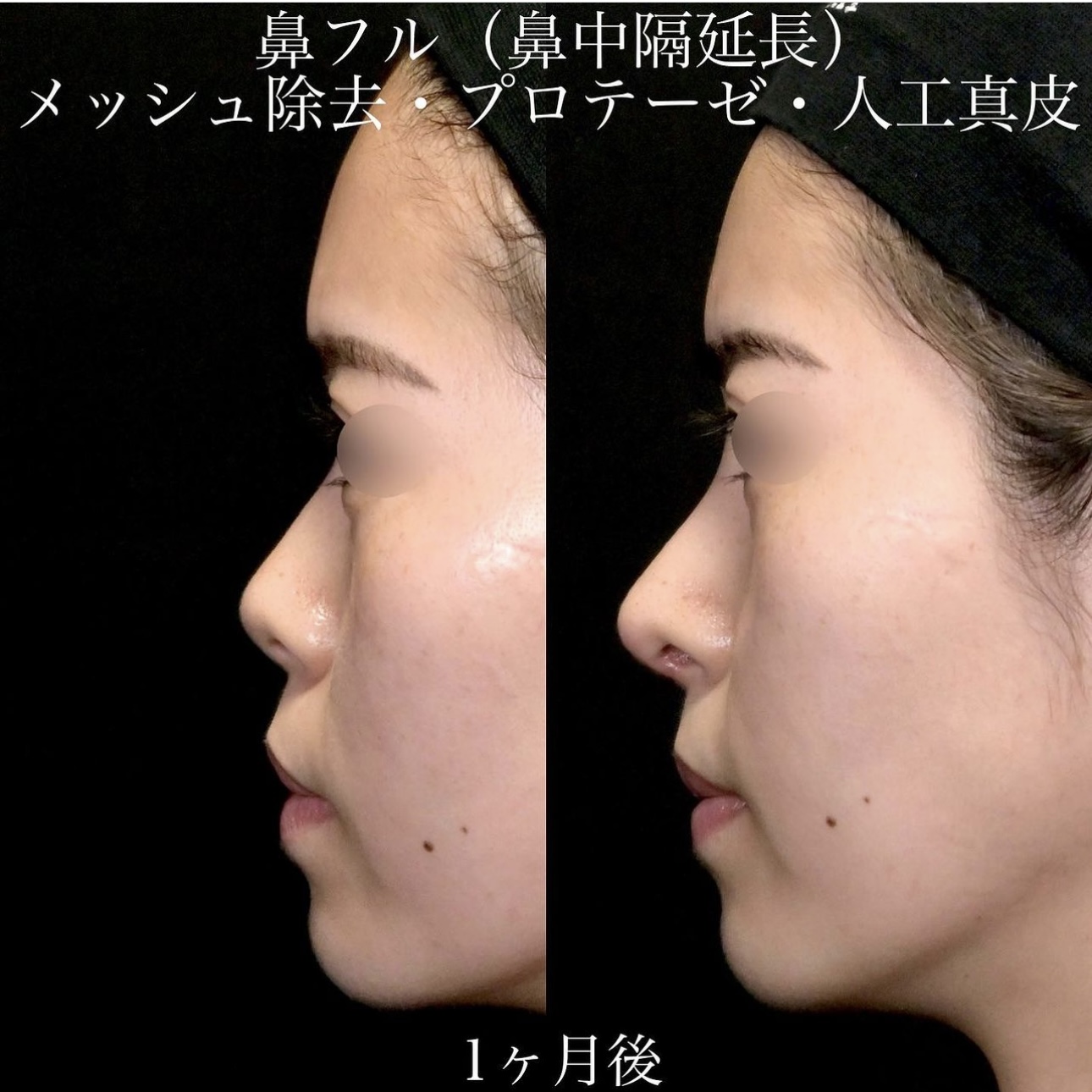 上木原医師による鼻整形の施術前／施術後1ヶ月 施術後 