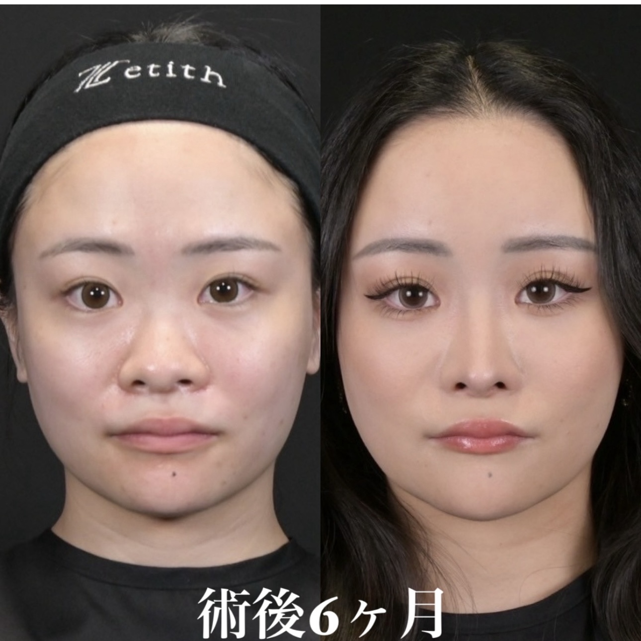鉄医師による鼻整形の施術前／施術後6ヶ月