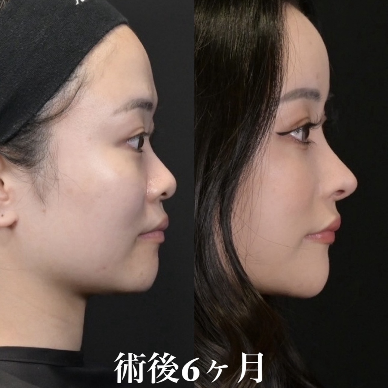 鉄医師による鼻整形の施術前／施術後6ヶ月 Sau 