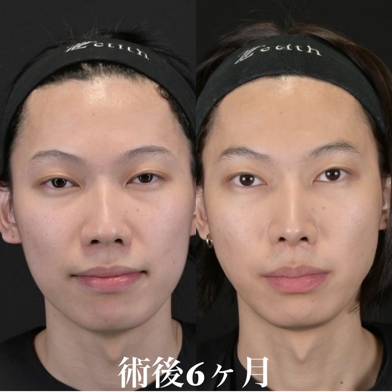 鉄医師による鼻整形の施術前／施術後6ヶ月