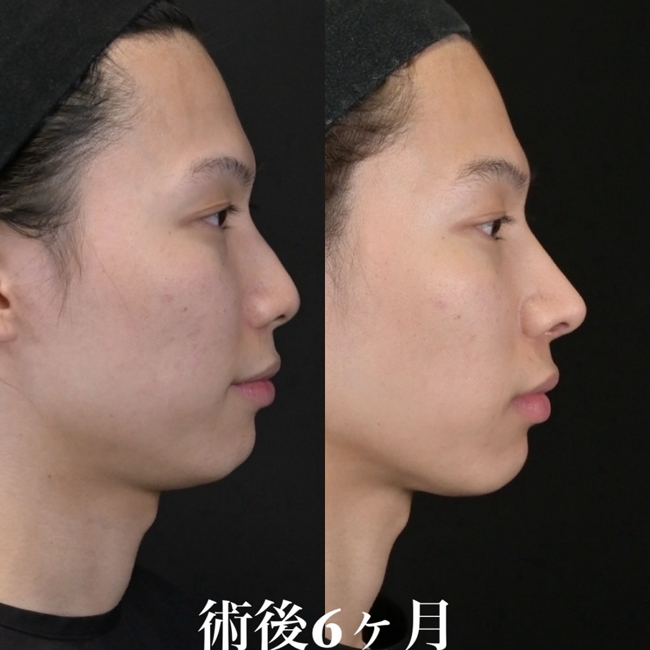 鉄医師による鼻整形の施術前／施術後6ヶ月 施術後 