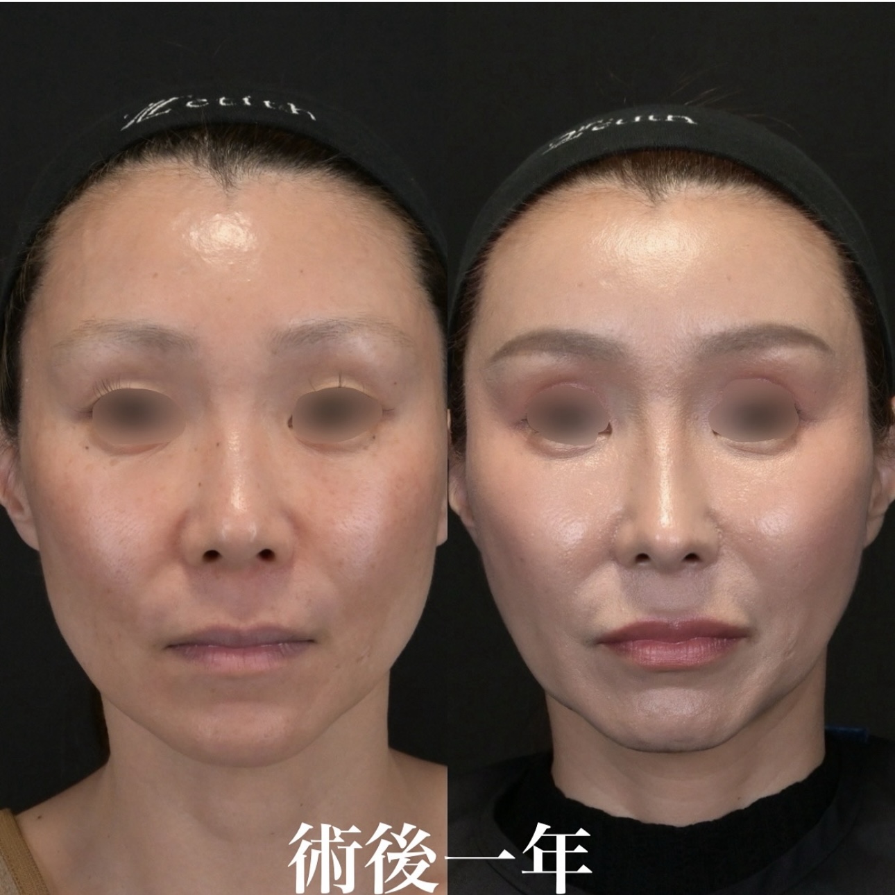 鉄医師による鼻整形の施術前／施術後1年